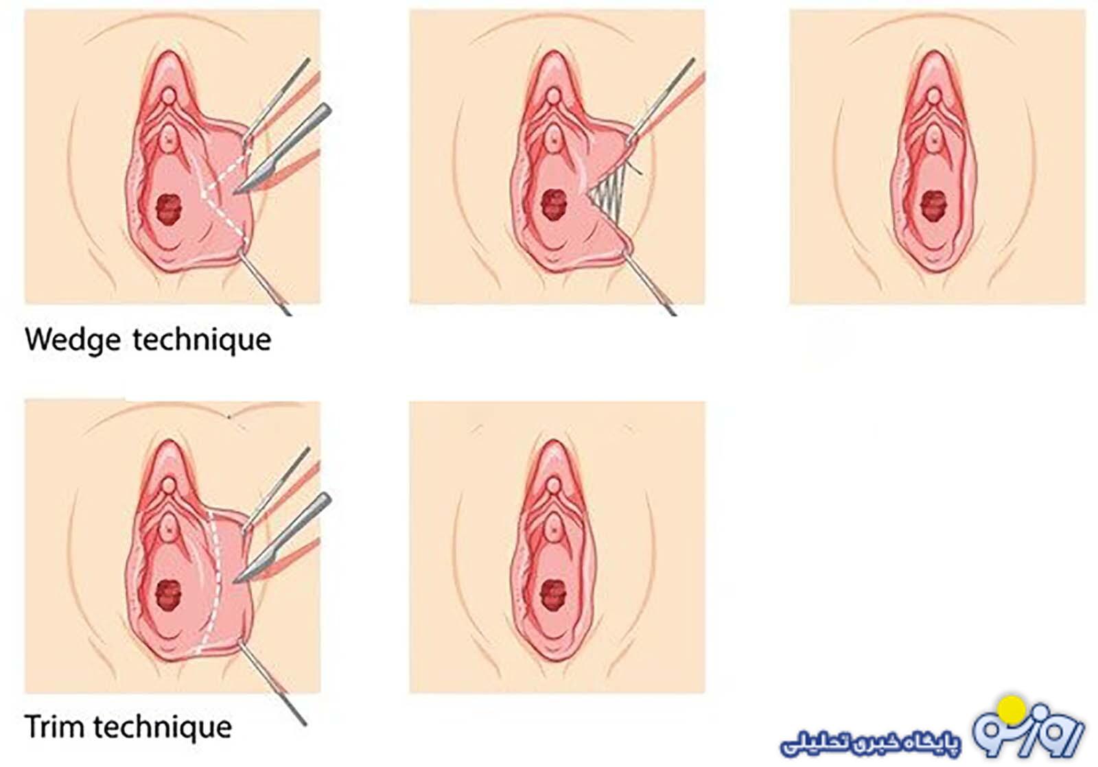 همه چیز درباره لابیاپلاستی؛ از شناخت تا انتخاب همه چیز درباره لابیاپلاستی؛ از شناخت تا انتخاب